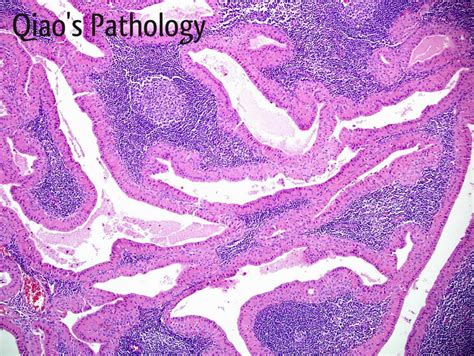 Qiaos Pathology Warthins Tumor Of Parotid Gland A Photo On Flickriver