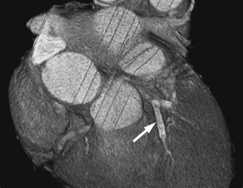Pitfalls Artifacts And Remedies In Multi Detector Row Ct Coronary