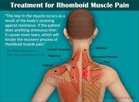 Pain Of The Rhomboid Muscle Is The Pain Which Is Present In The Upper
