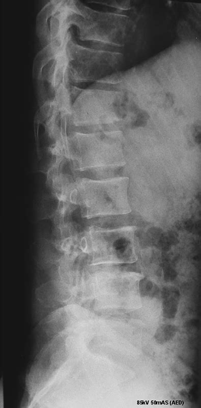 Lateral Lumbar Spine Breathing Technique WikiRadiography