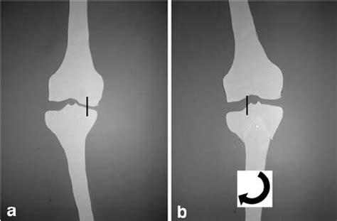 A crown in head would define the horisontal plane. The coronal plane osteotomy requires a single tibial cut ...