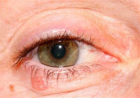 Eyelid Cancer Biopsy The Eyelid Institute