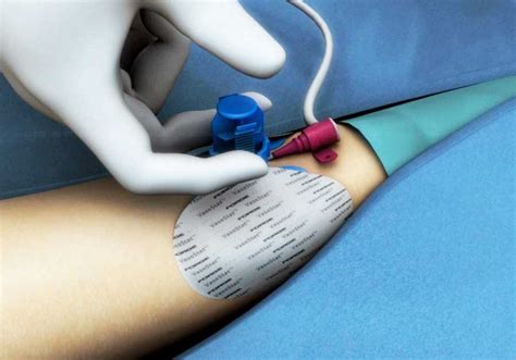 Radial Artery Catheterizationmedical Device Animation