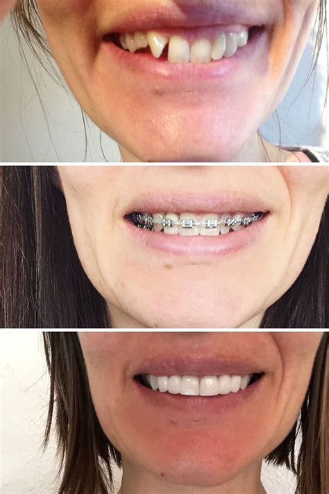 Pin on Perfect Teeth Before And After