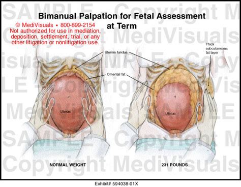 Bimanual Palpation For Fetal Assessment At Term Medivisuals