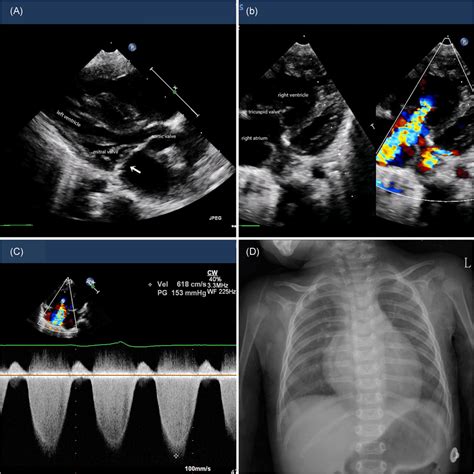 A‐c Transthoracic Echocardiography Images Confirmed The Cor