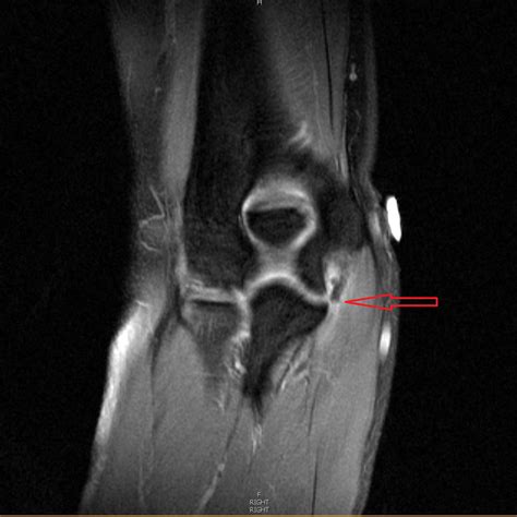 Ulnar Collateral Ligament Elbow Mri
