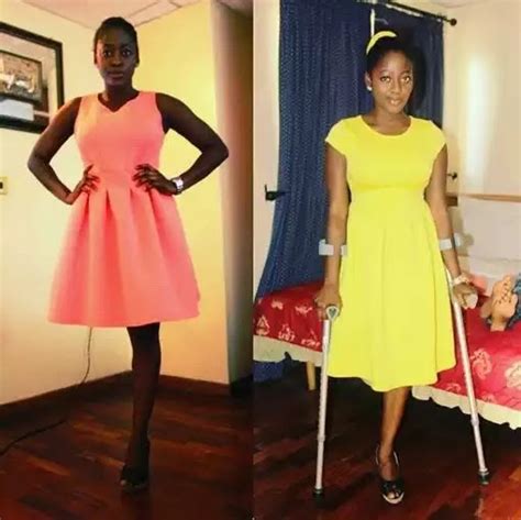 Beautiful 20 Year Old Nigerian Celebrates 7 Years Of Being An Amputee