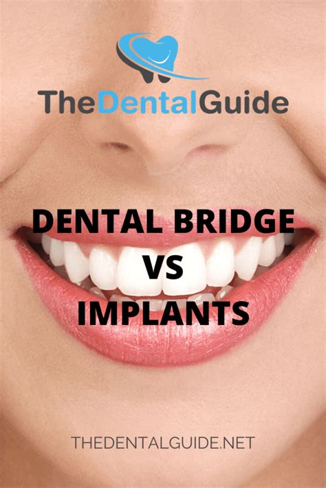 Dental Bridge Vs Implants The Dental Guide