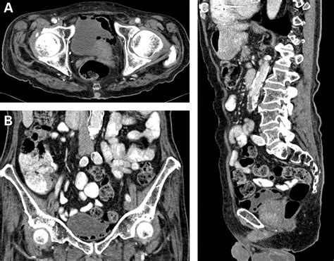 Emphysematous Cystitis Radiological Diagnosis Of Complicated Urinary