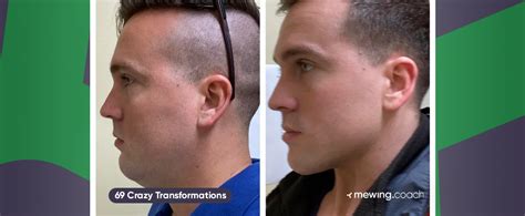 Mewing Before And After Results 70 Crazy Transformations
