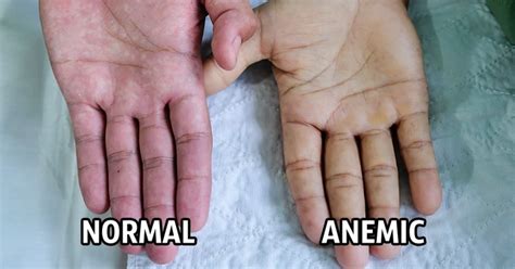 Signs And Symptoms Of Shortage Of Blood And Oxygen In The Body Anemia