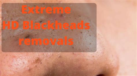 Extreme Hd Blackheads Extractions Youtube