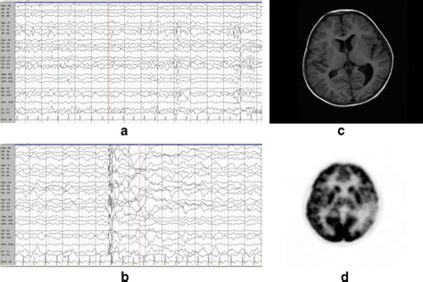 A Interictal Eeg Showing Focal Irregular Slowing And Attenuation In The