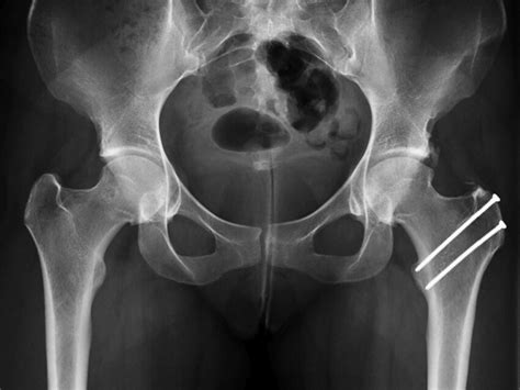 Final Postoperative Anteroposterior Pelvic Radiograph From The Patient