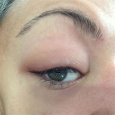Puffy Swollen Red Eyelids How To Treat Blepharitis Youmemindbody