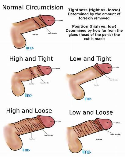 Circumcision Styles Types Different Tight Penis Cut