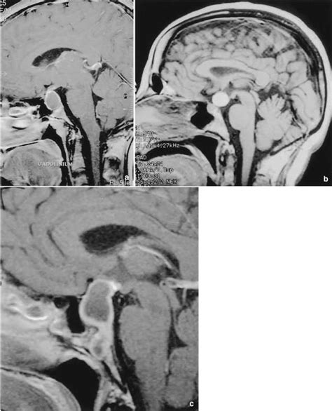 A Enhanced Sagittal Image Showing A Pituitary Cyst With Low Signal