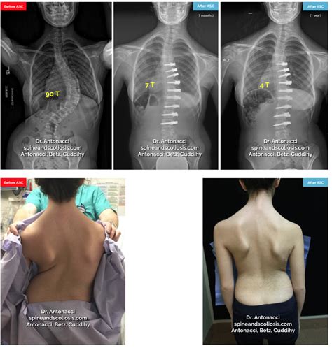 Before And After Scoliosis Surgery With Darryl Antonacci