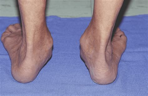 Flatfoot Deformity Footcare Friday Alpine Orthopedics And Sports Medicine Orthopedic Surgery