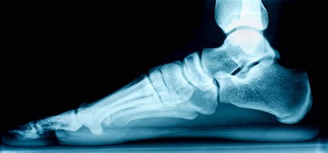 Charcot Foot Causes Diagnosis Treatment And More