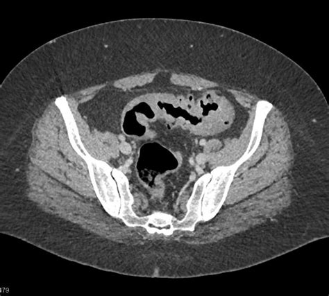 Imaging In Diverticulitis Of The Colon Overview Radiography Computed