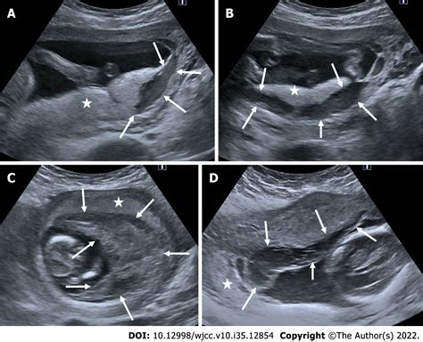 Antenatal Imaging A Pictorial Review