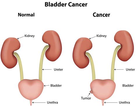What Are The Different Bladder Tumor Symptoms With Pictures