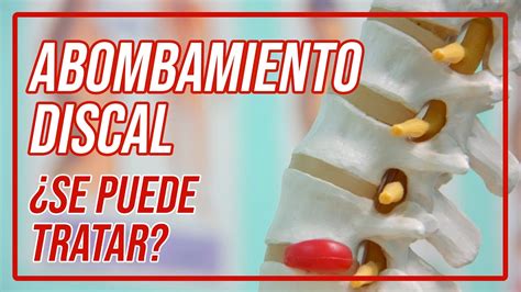 Hernia Qué Es Causas Y Tipos De Lesiones Del Disco Intervertebral