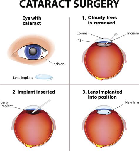 Eye Surgery For Cataracts Pterygiums Eyelid Lesions And Ptosis Ace