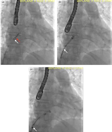 Gore Cardioform Atrial Septal Occluder Deployment Procedure And