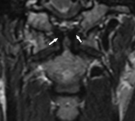 Imaging Of Atlanto Occipital And Atlantoaxial Traumatic Injuries What