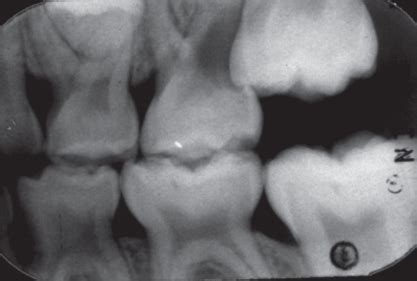 Ectopic Eruption Of Maxillary First Permanent Molar Pocket Dentistry