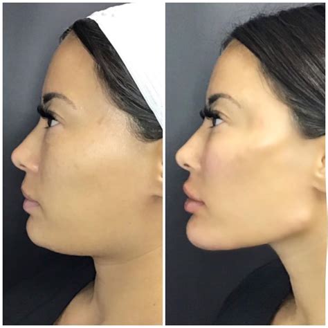 How Much Are Fillers For Chin Face Forward Aesthetics