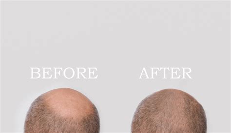 How To Regrow Hair On Bald Spot In A Matter Of Weeks Ultimate Guide