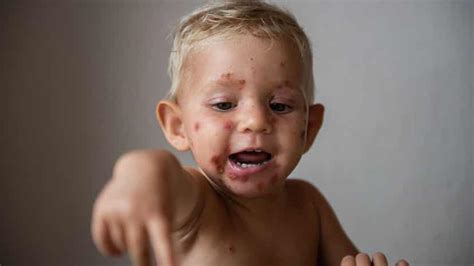 Impetigo Em Crianças Passo à Saúde