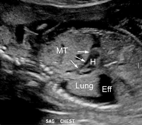 A Sagittal Gray Scale Ultrasound Image In A 21 Week Fetus With