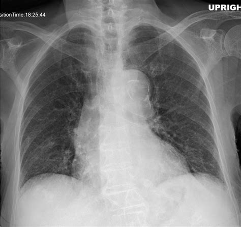 Aortic Dissection An X Ray Sign Emergency Medicine Jo