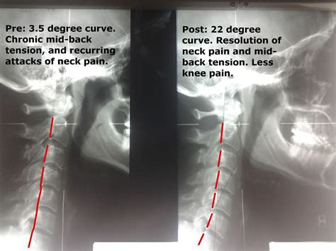 Tag Qsm3 Chiropractor Auburn Hills Mi 48326 Upper Cervical Care