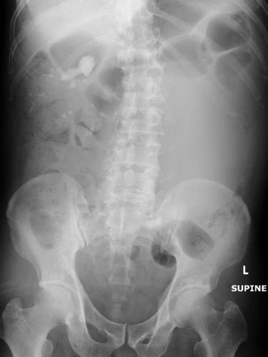 Plain Radiograph Of The Abdomen Showed Multiple Right Renal Stones