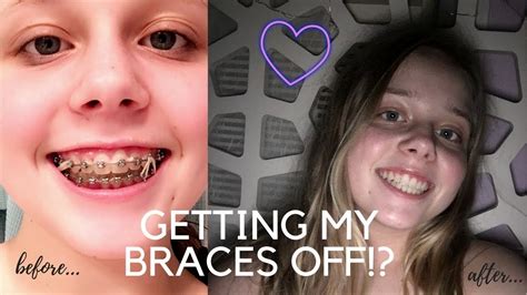 Getting My Braces Off Youtube