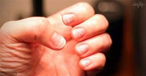 White Spots On Nails Due To Zinc Deficiency Nail Ftempo