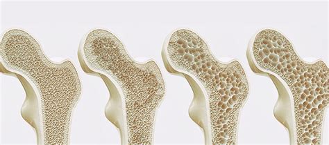 Osteoporosis Y Ph Inat México