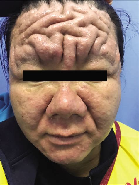 A Case Of Cutis Verticis Gyrata Related To Pregnancy Indian Journal