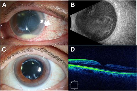 Radial Keratotomy Associated Endophthalmitis Ophthalmology Retina