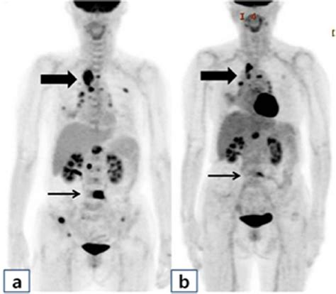 Figure1 18 F Fdg Pet Imaging Showing Hypermetabolic Lesions An
