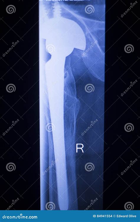 Hip Joint Replacement Xray Stock Photo Image Of Body 84941554