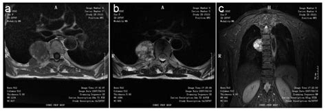 Osteoblastoma Of The Rib With Ct And Mr Imaging A Case Report And