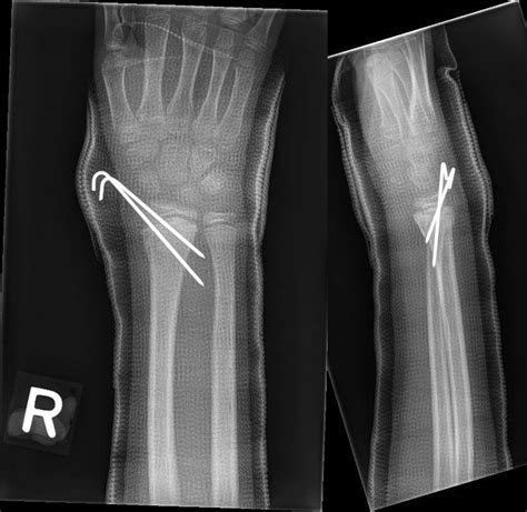 Displaced Paediatric Distal Radius Fractures With Volar Skin Tenting