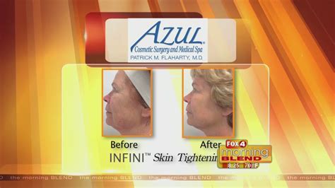Azul Cosmetics Surgery And Medical Spa 111016 Youtube